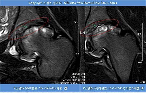 고관절염/뉴시스