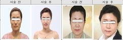 사진 조작해 성형효과 부풀린 병의원 무더기로 적발